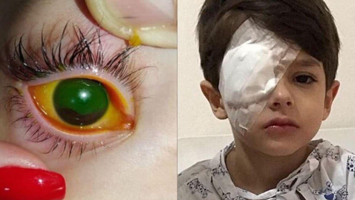 Menino sofre lesão devido ao álcool em gel - reprodução Instagram / Pinterest