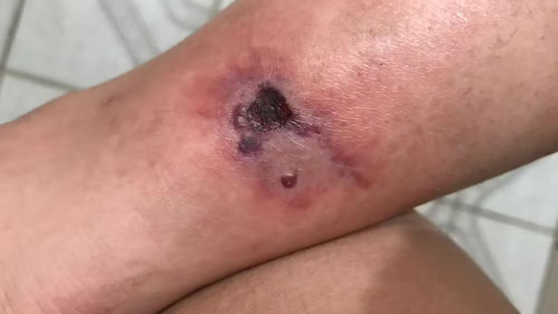 Perna necrosada após picada