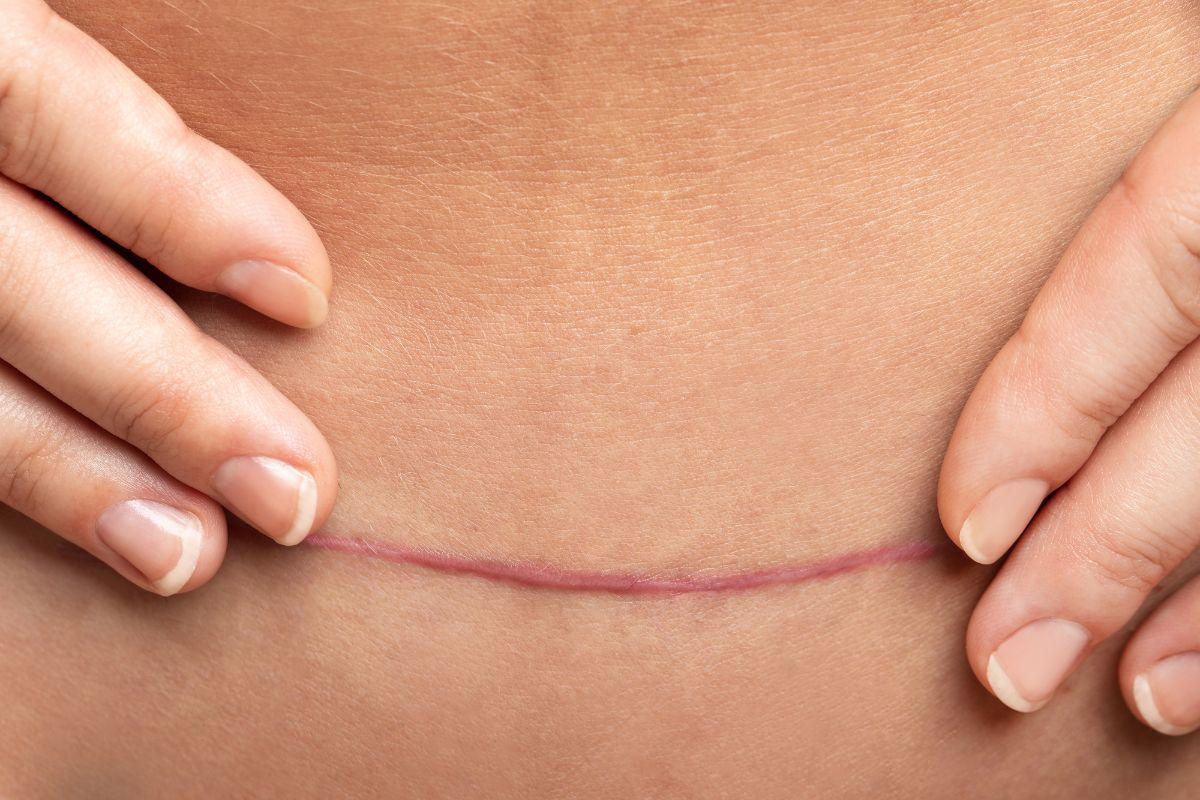 4 dicas para cuidar da cicatriz de cesárea - Kinedu Blog