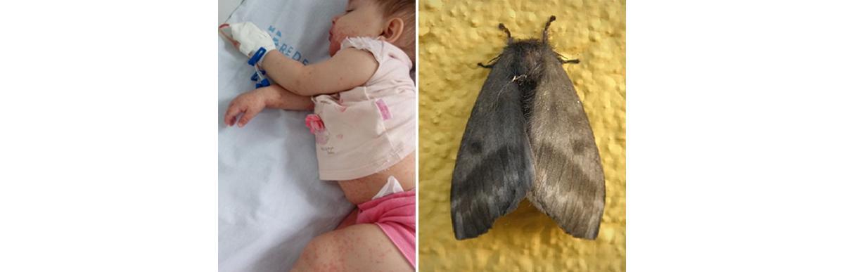 Mãe faz alerta após filha de 8 meses ter grave reação alérgica ao brincar com mariposa