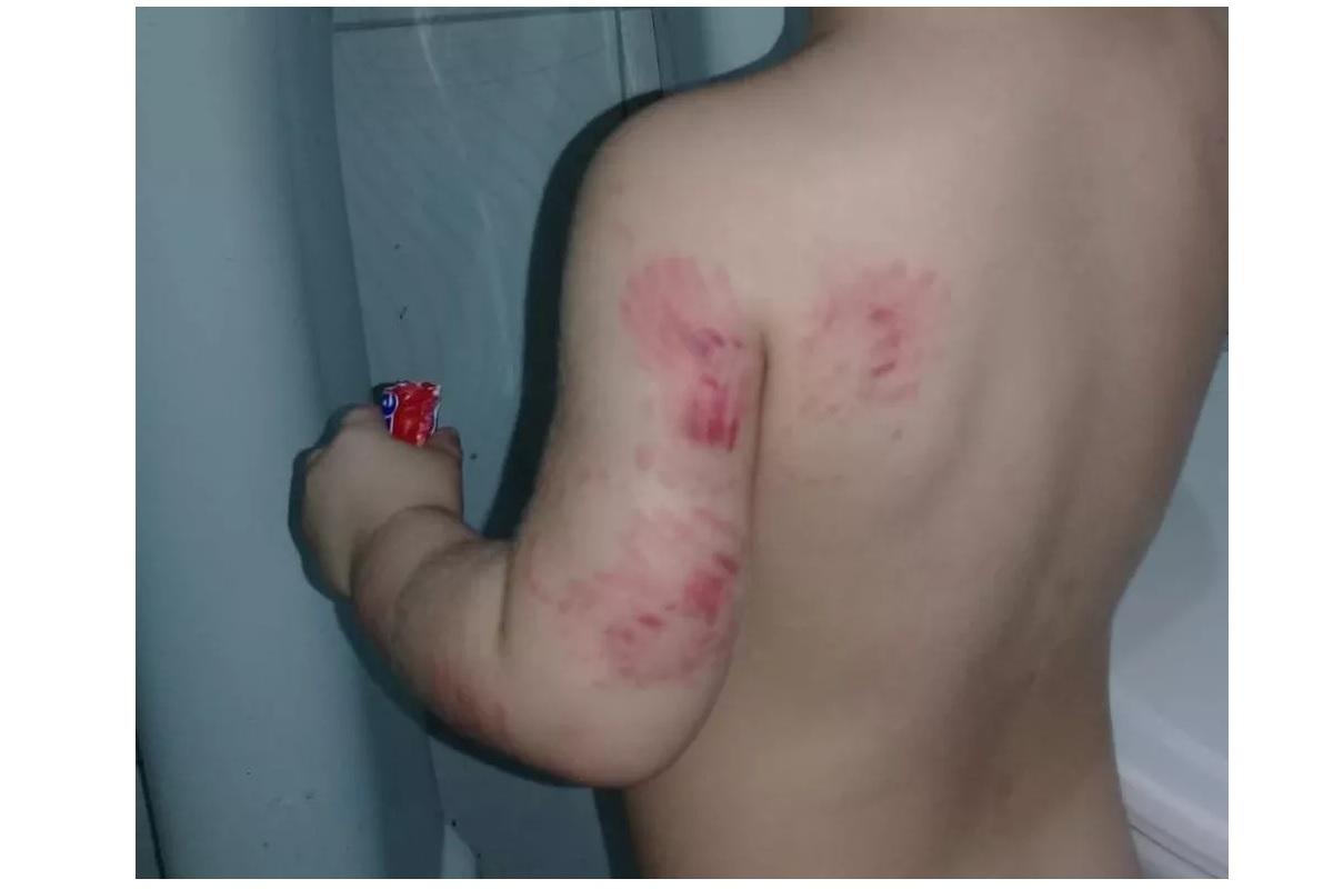 Bebê é agredido com mordidas em creche e mãe faz desabafo: “Quero que a justiça seja feita”