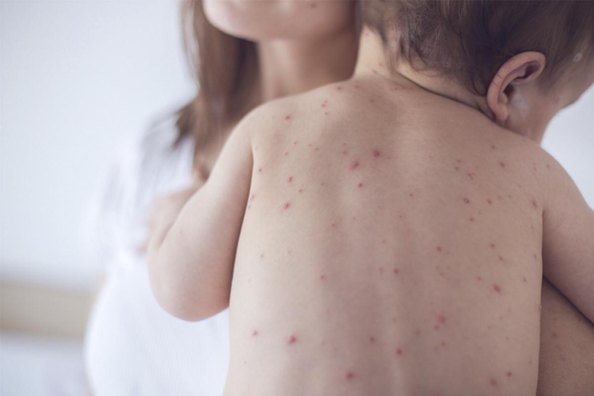 Vacine seu filho contra o Sarampo, é muito importante