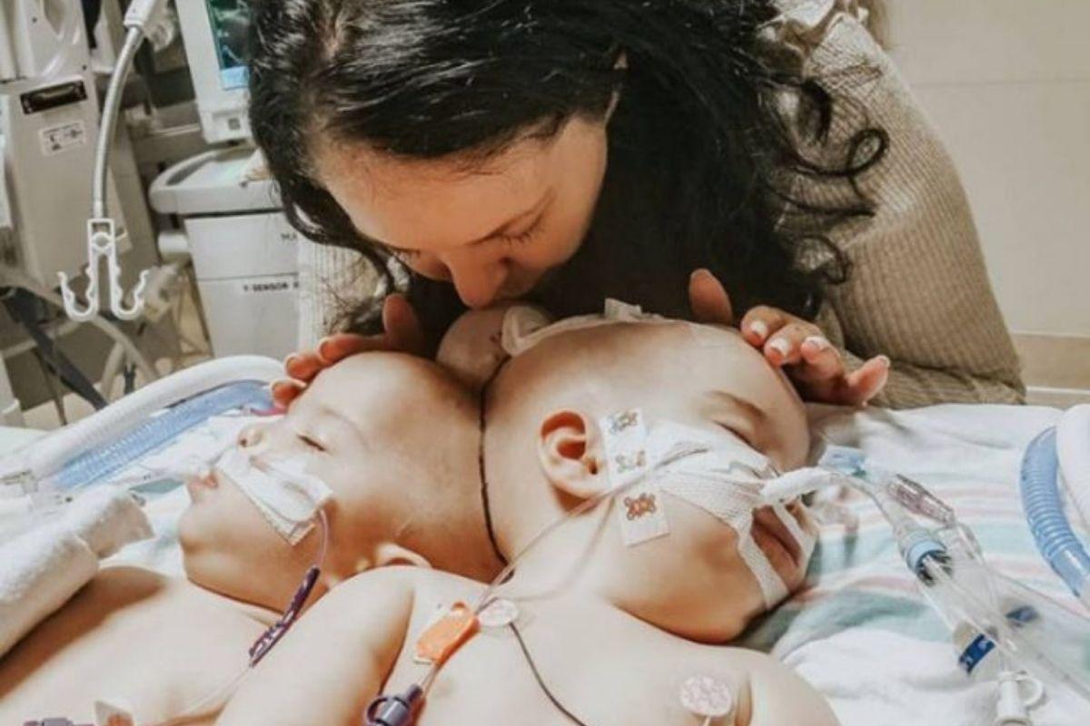 Vitória! Gêmeas siamesas unidas pela cabeça são separadas em cirurgia histórica de 24 horas