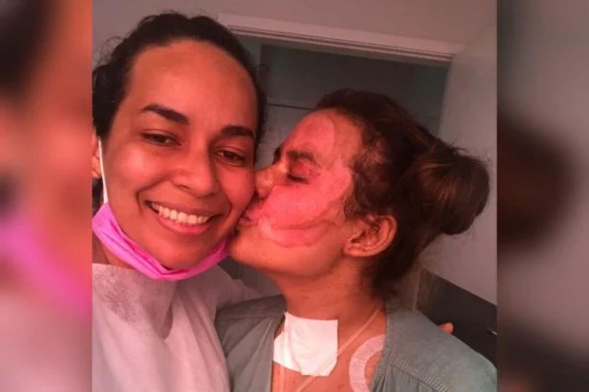 Annelise já realizou dois enxertos de pele e aguarda a resposta médica para saber se haverá a necessidade de fazer um terceiro