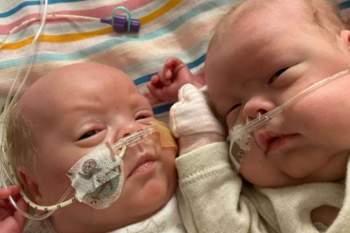 Os gêmeos prematuros nasceram com 5 meses de gestação e precisaram passar por 6 cirurgias e 25 transfusões de sangue