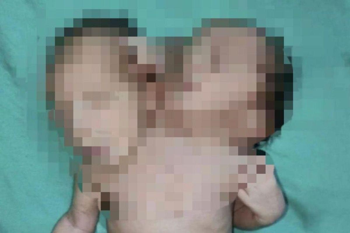 O raio-x dos gêmeos foi divulgado nesta sexta-feira