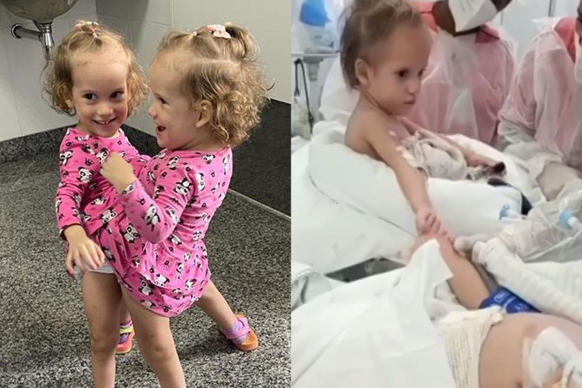 Após cirurgia de risco, gêmeas siamesas que foram separadas emocionam os médicos ao darem as mãos