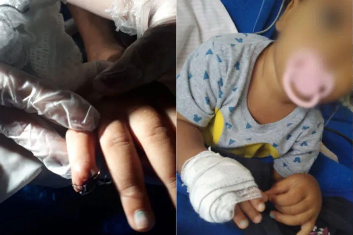 A bebê teve parte do dedo amputado