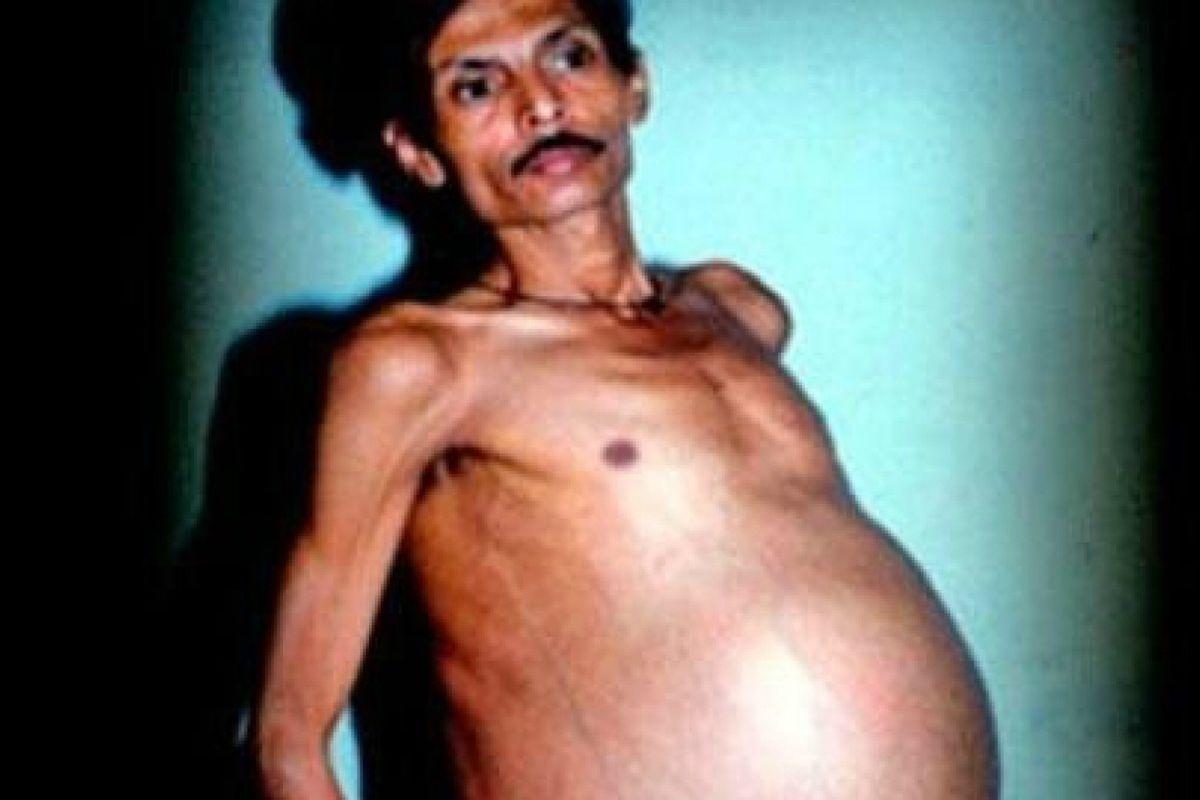 Homem fica ‘grávido’ por 36 anos e tem descoberta surpreendente sobre seu caso raro