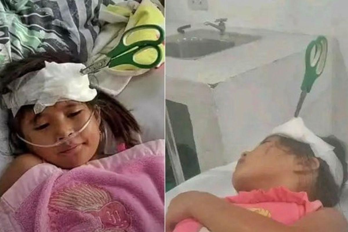 Menina fica com tesoura presa na cabeça após brigar com o irmão em sua casa