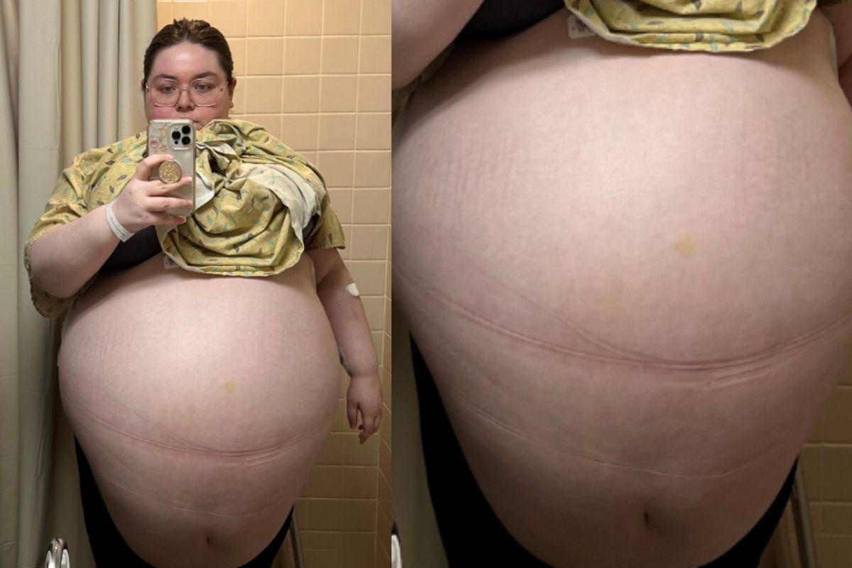 Allison tinha um tumor de 47 kgs
