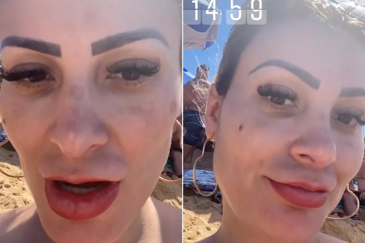 Melasma de Andressa Urach