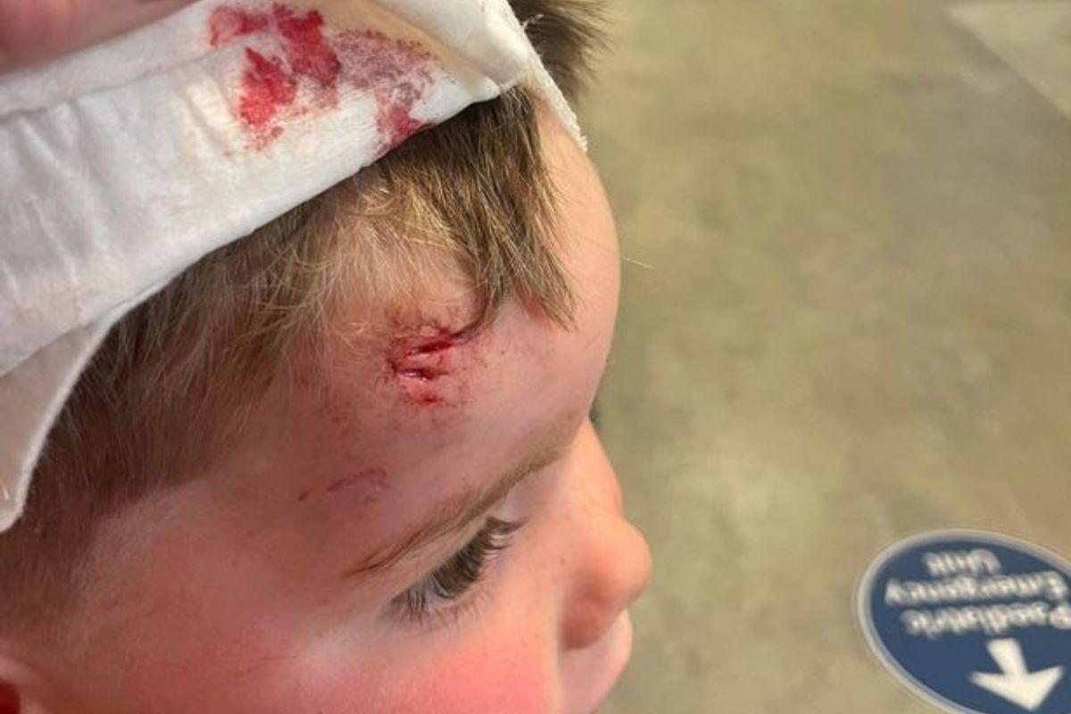 O menino ficou com machucados no rosto após ser atropelado por ciclista