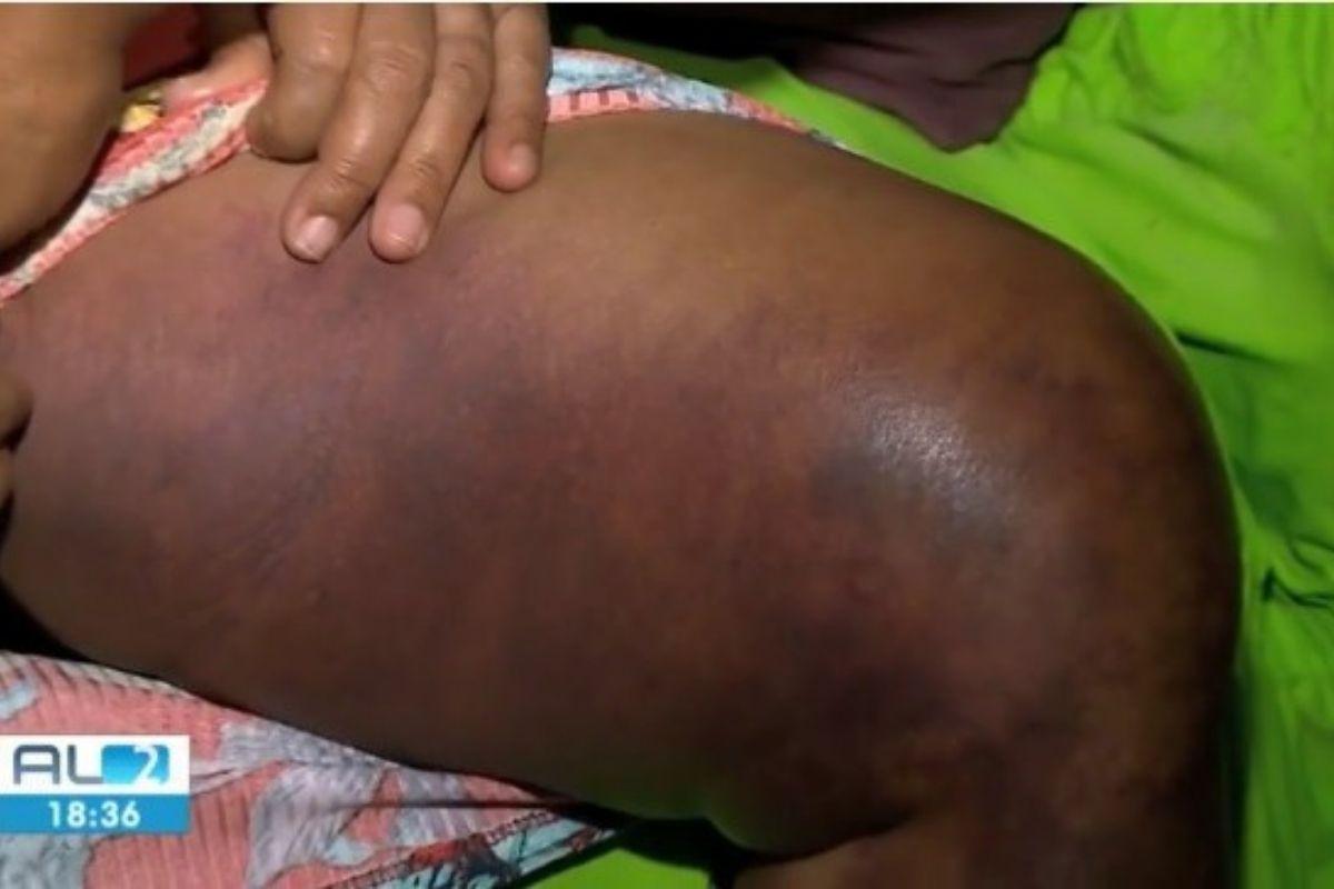 A mulher ficou com fortes hematomas no corpo