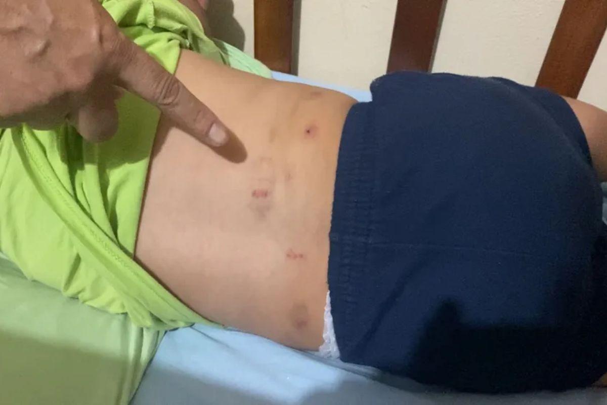 Criança mordida