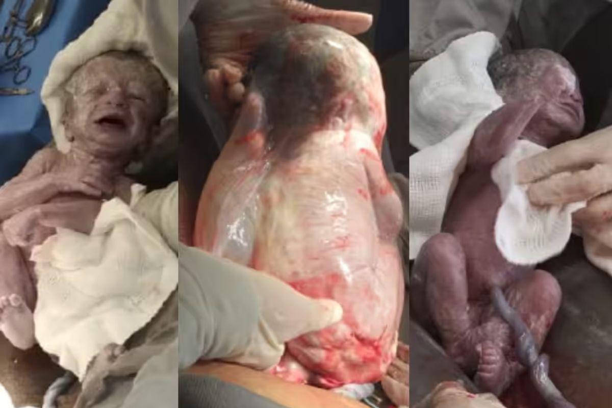 Três bebês envolvidos pela bolsa amniótica logo após o parto