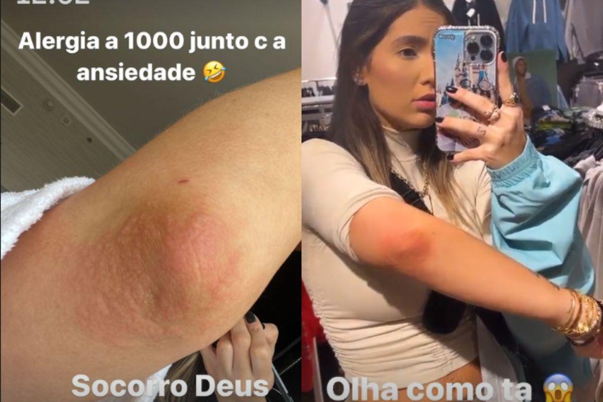 Virginia mosra como está a alergia