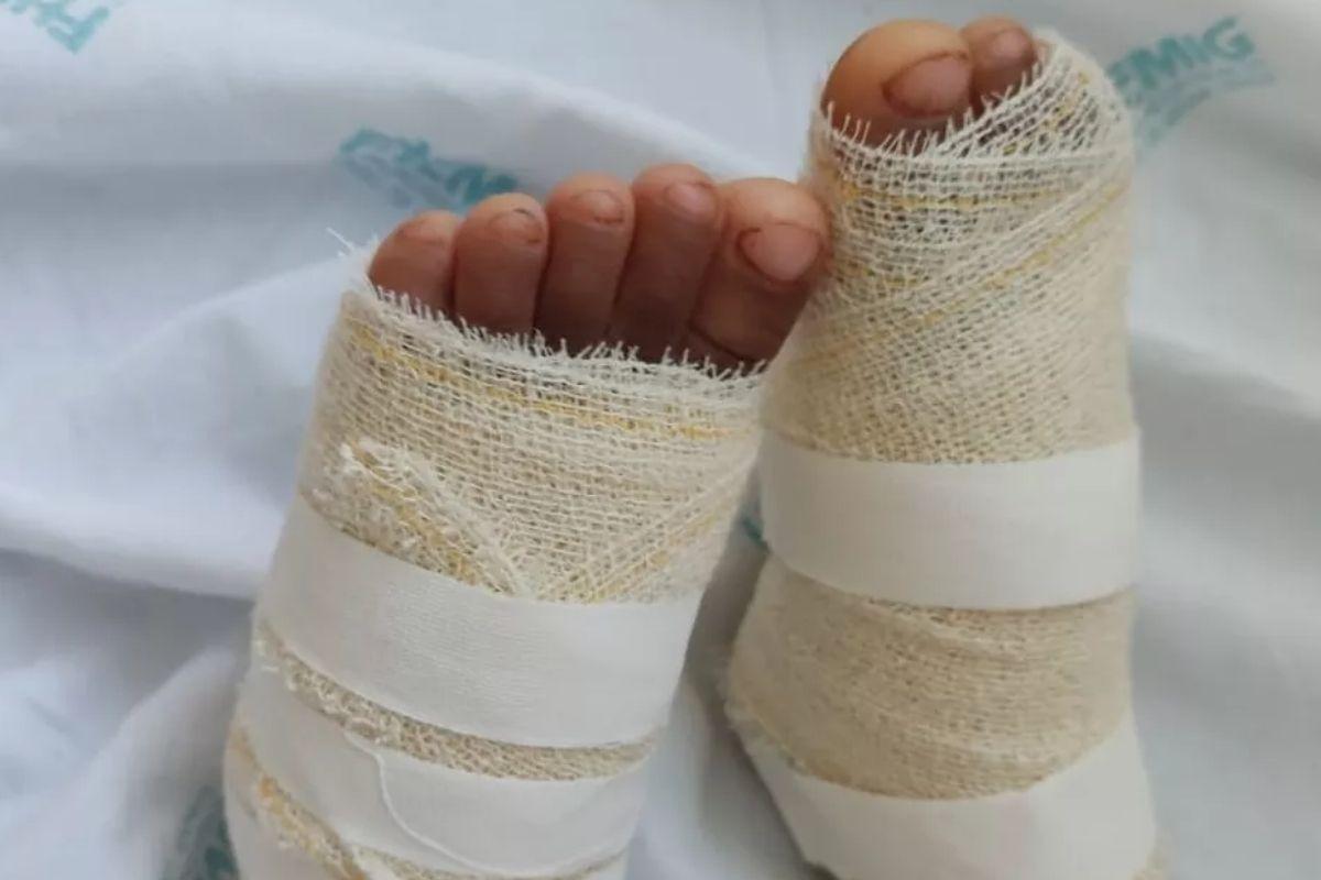 A menina apareceu com queimaduras nos pés