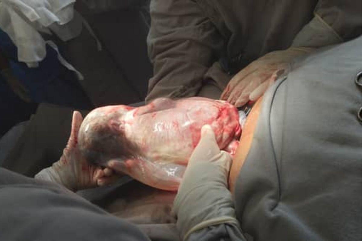 Bebê envolvido pela placenta logo após seu parto.