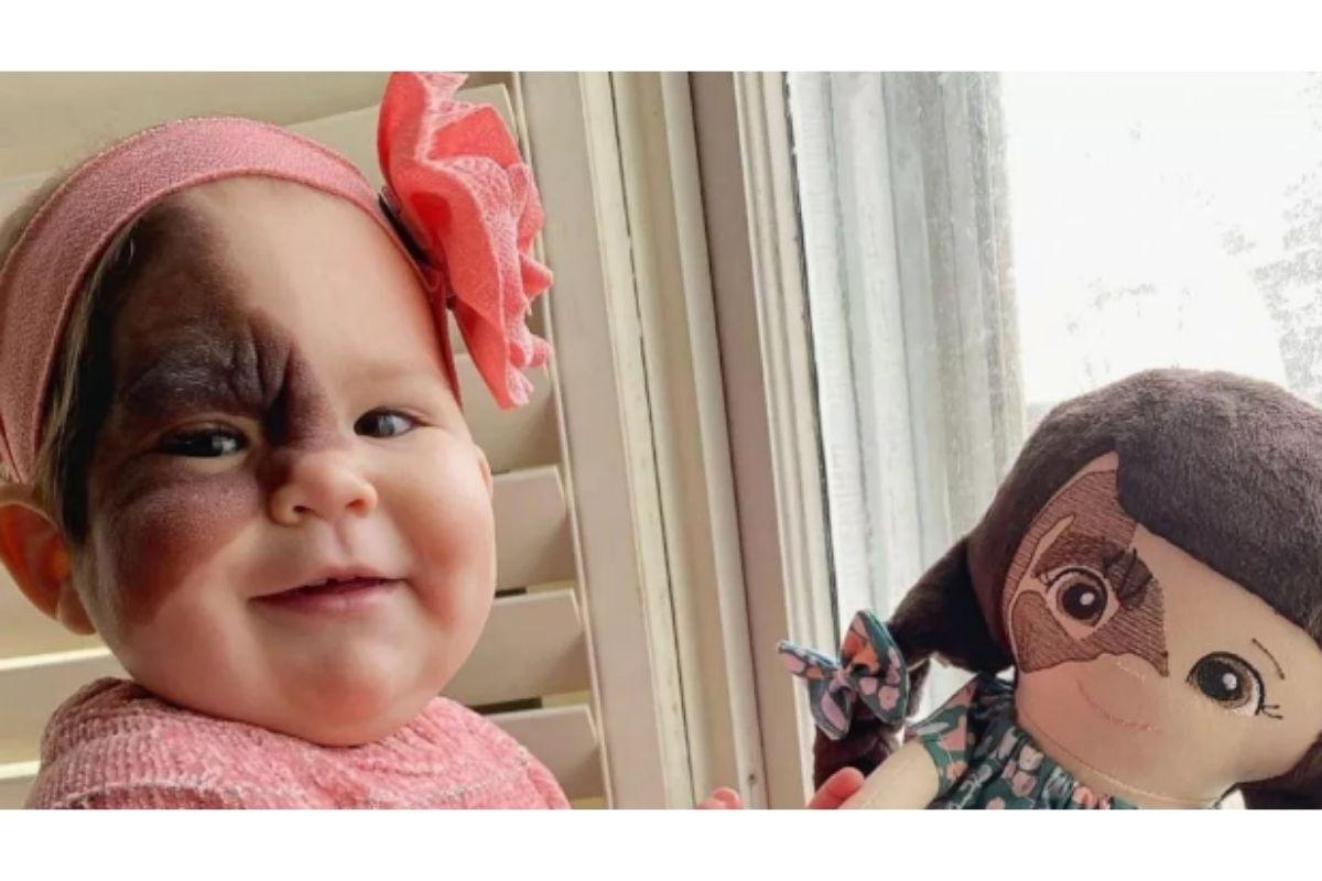 Mãe faz desabafo para conscientizar outros pais sobre marca de nascença da filha