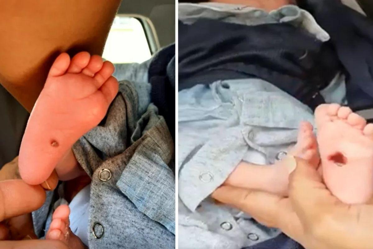 O bebê teve queimaduras nos dois pés