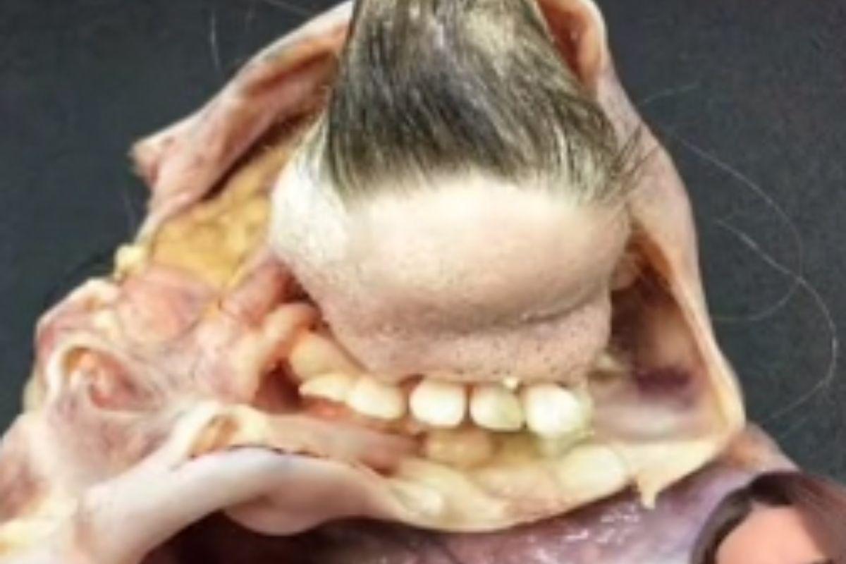 Tumor Teratoma