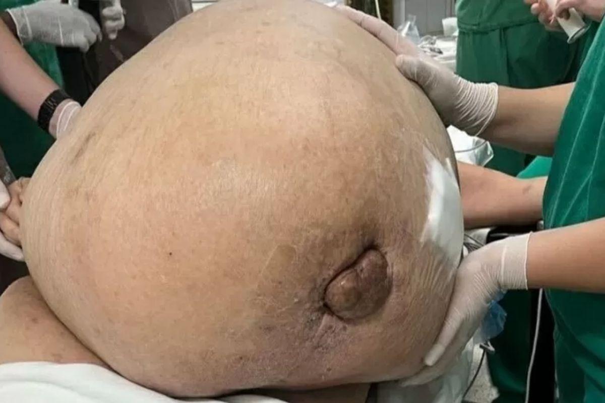 A mulher viveu com o tumor de 46 quilos por cinco anos