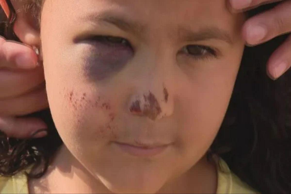 A menina de 5 anos foi levada para o hospital pelos pais