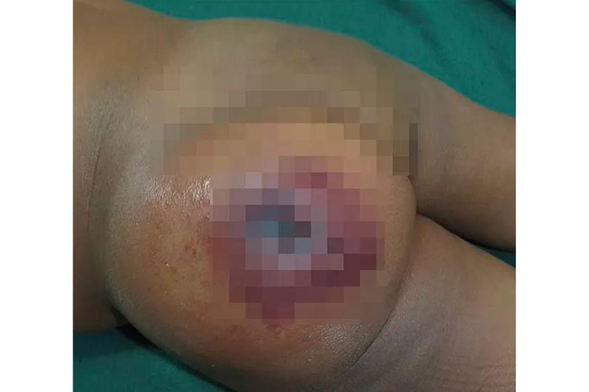 Menino de 1 ano foi contaminado por antraz