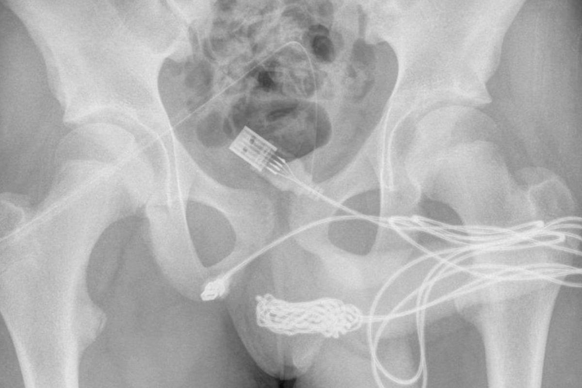O adolescente passou por uma cirurgia por conta do cabo