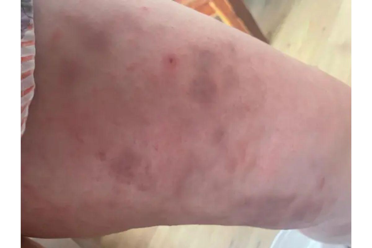 Hematomas causados por aranha na Tracy