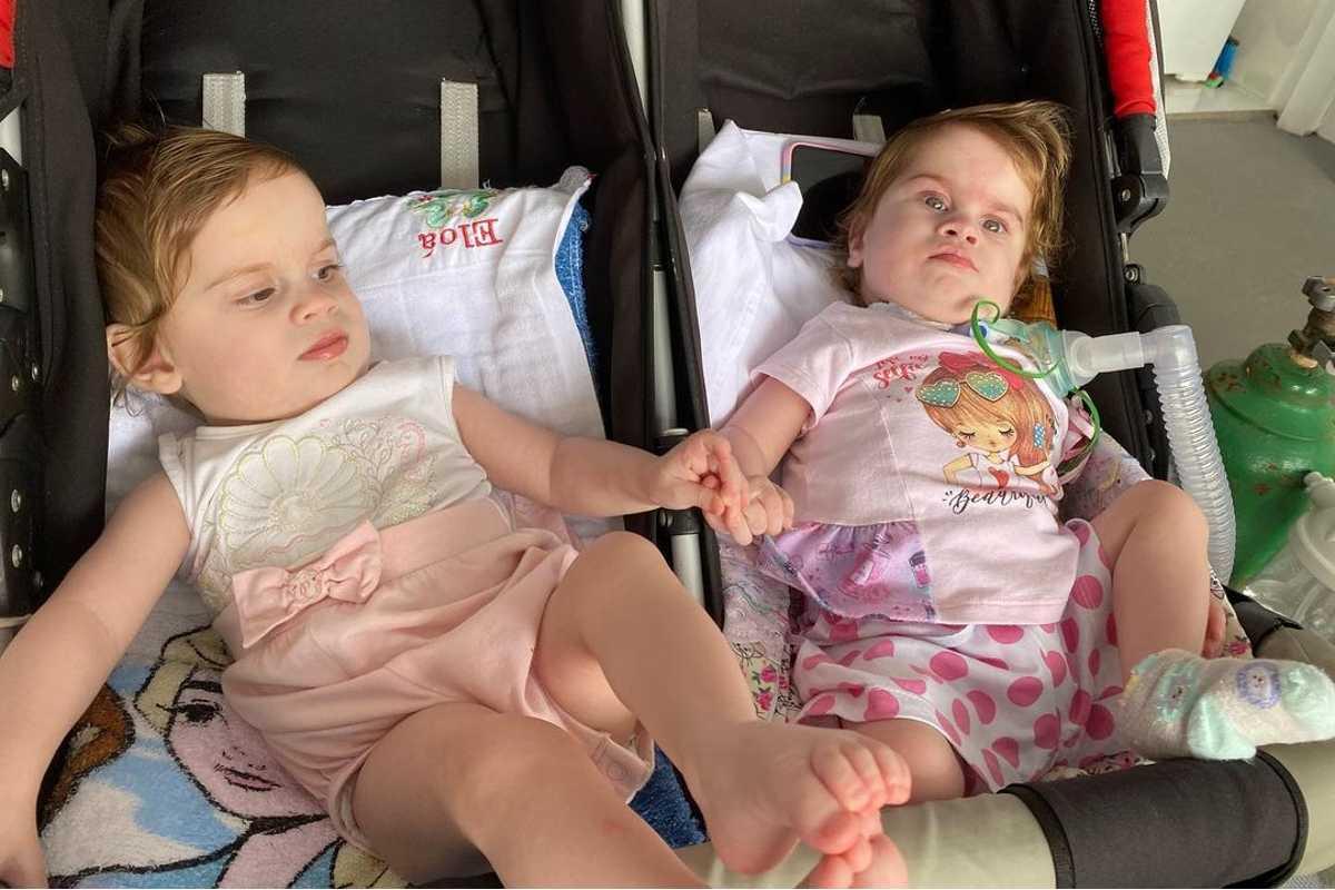 Após 2 anos da cirurgia, gêmeas siamesas apresentam quadro de saúde estável