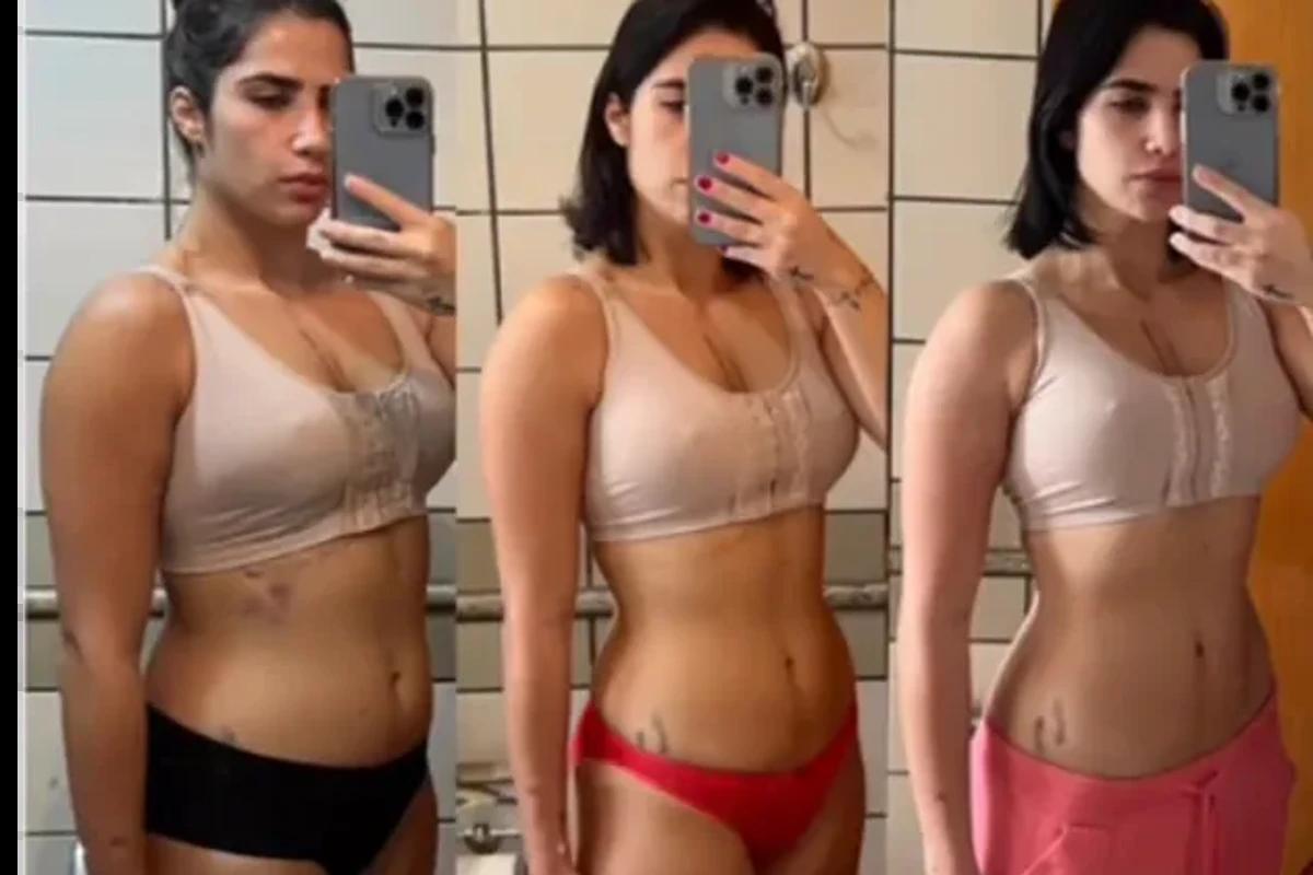 Mulher em pós-operatório do silicone