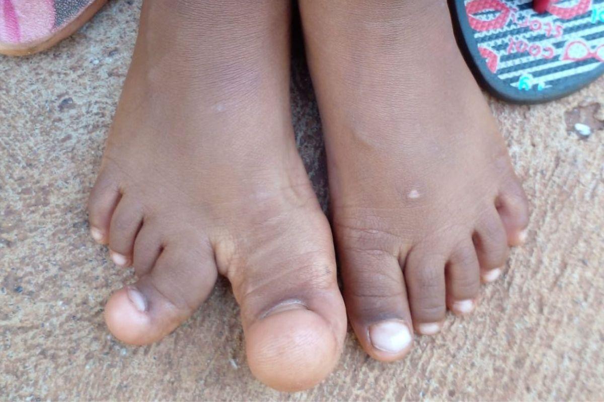 Dedos de criança de 3 anos se alongam mais que o normal e pais procuram diagnóstico mais preciso (Foto: Reprodução/Mídia Max)