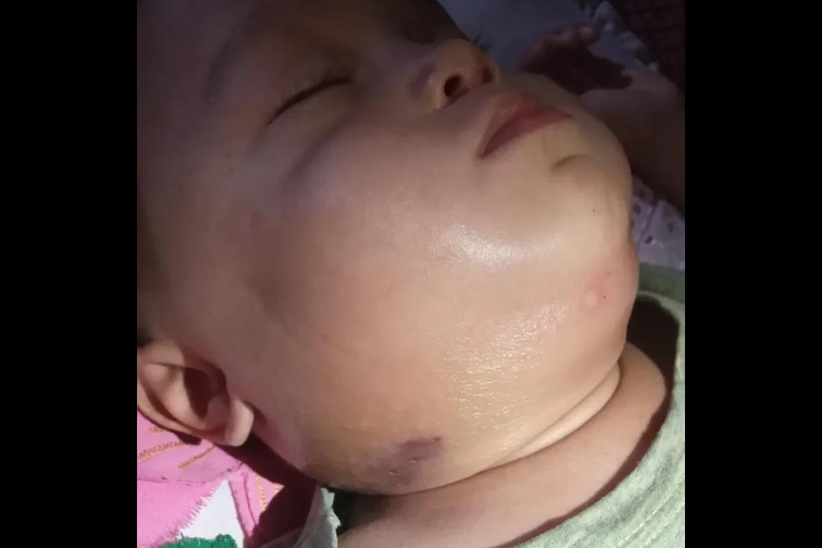 Bebê com pescoço inchado e marca roxa