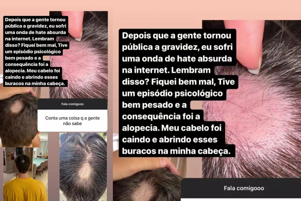 Eliezer explica sobre alopecia
