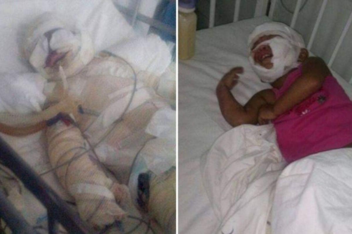 As meninas sofreram queimaduras de terceiro grau