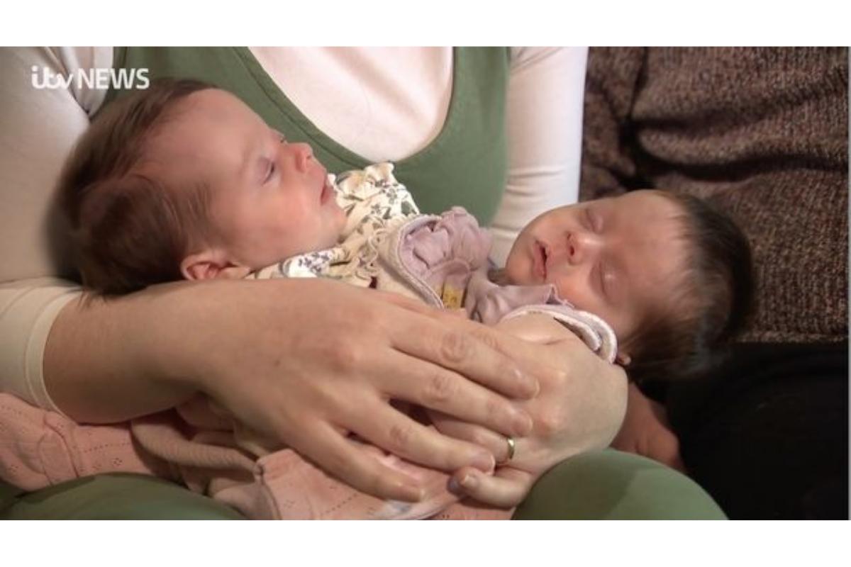 Gêmeas siamesas nascem se abraçando constantemente e mãe diz ser milagre