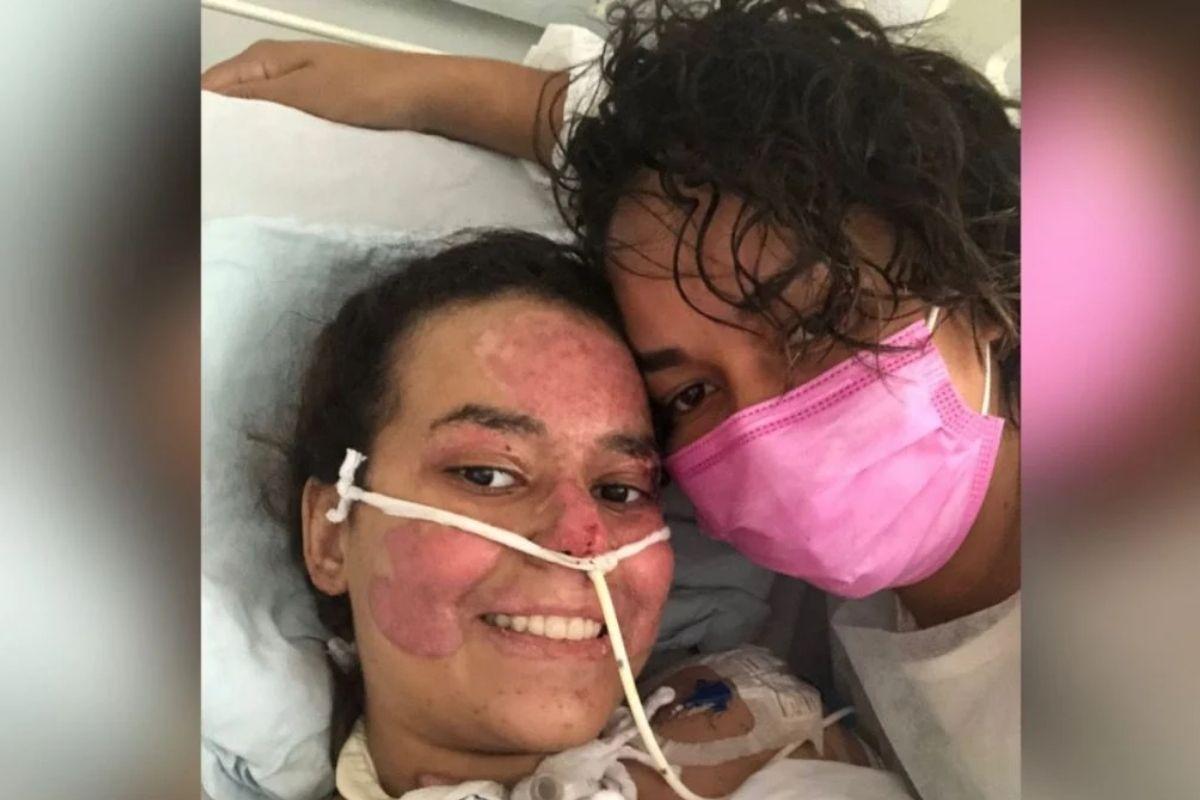 Annelise já realizou dois enxertos de pele e aguarda a resposta médica para saber se haverá a necessidade de fazer um terceiro