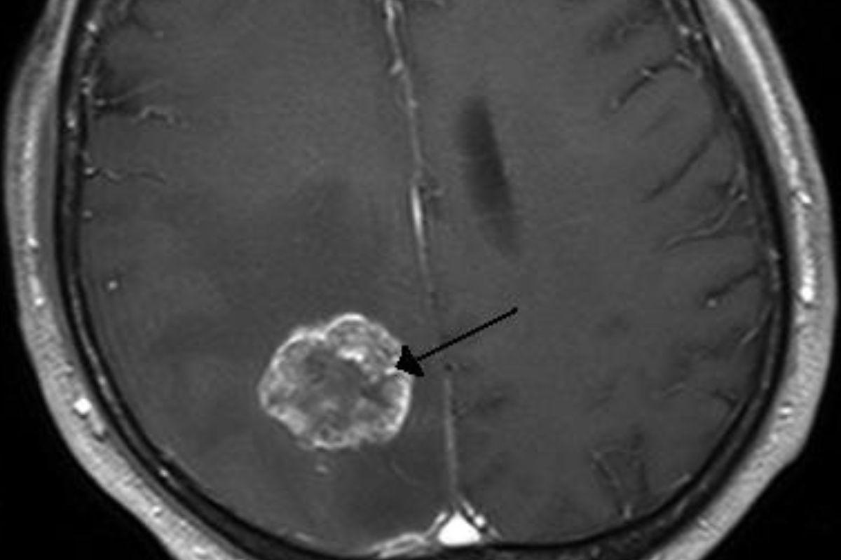 Menino de 15 anos recebe diagnóstico de tumor cerebral após sentir dores na cabeça e tontura (Foto: reprodução/Wikipedia)