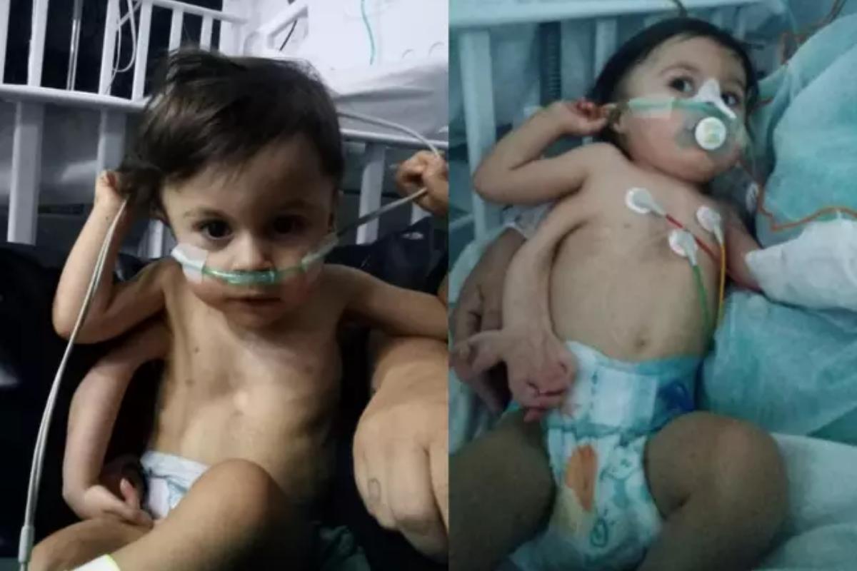 Bebê nasce com três braços em caso raro