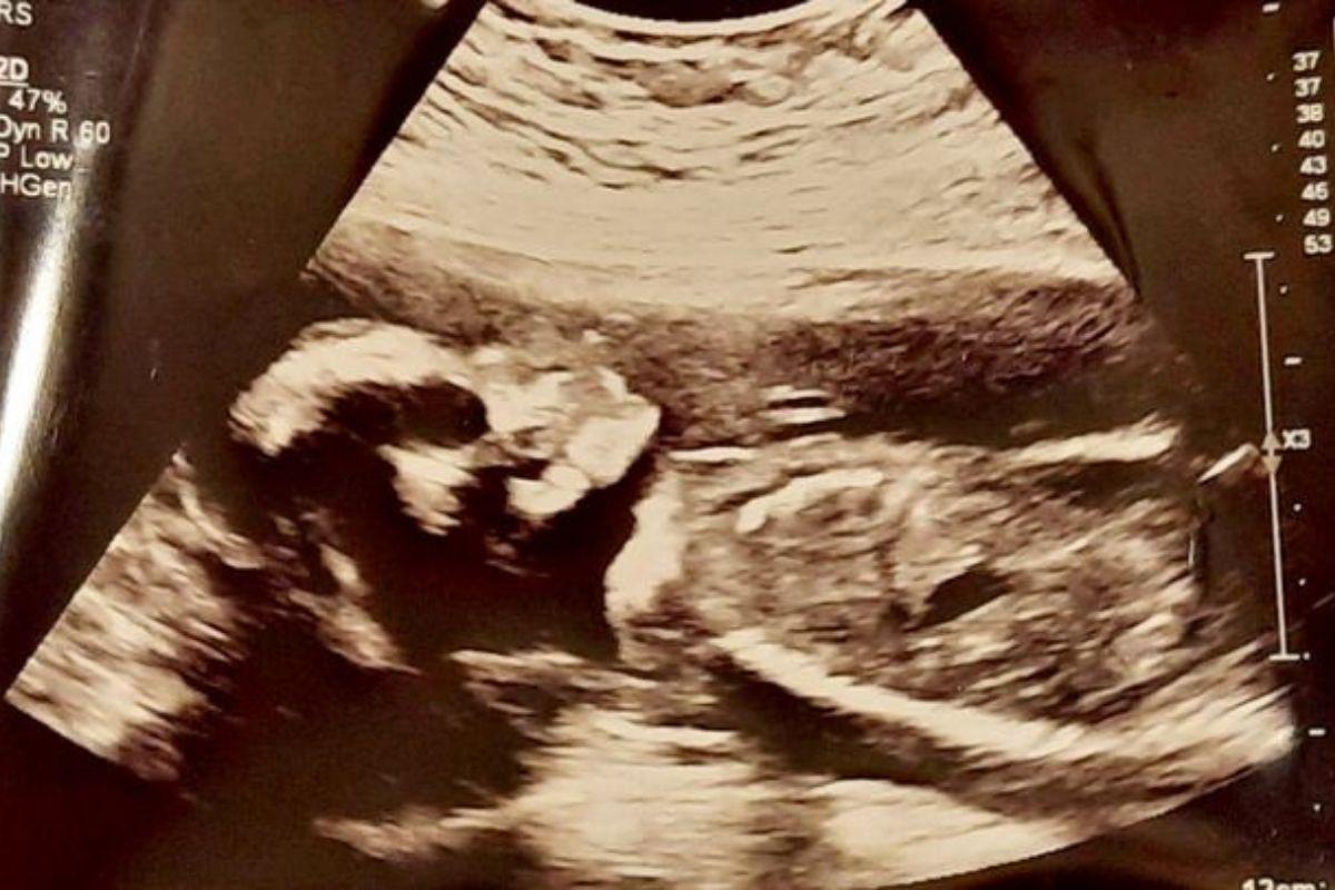Mãe fica assustada com ultrassom da filha: "O crânio apareceu"