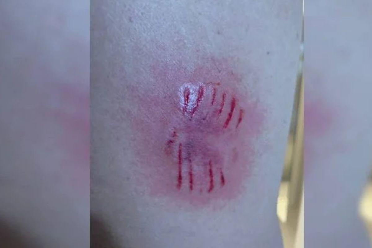 Criança é atacada por matilha de cães e pai é mordido ao tentar salvar filha