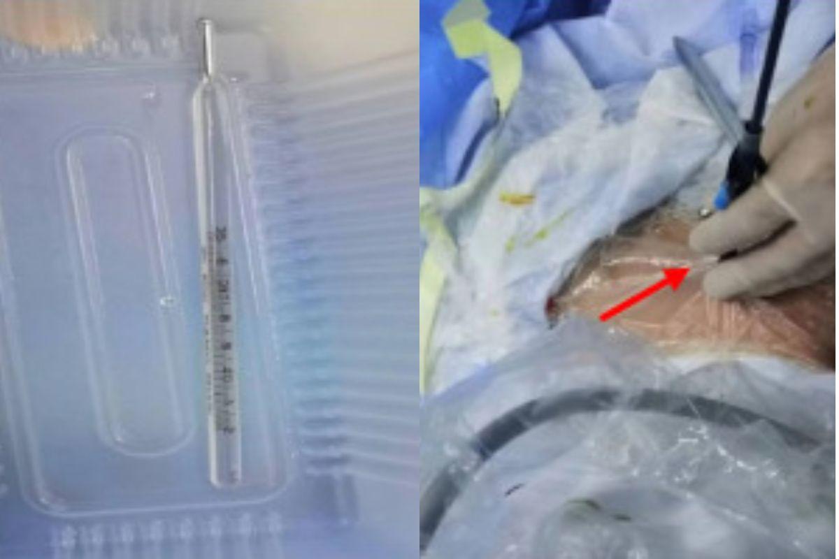 Menino de 12 anos insere termômetro no pênis e passa por cirurgia (1)