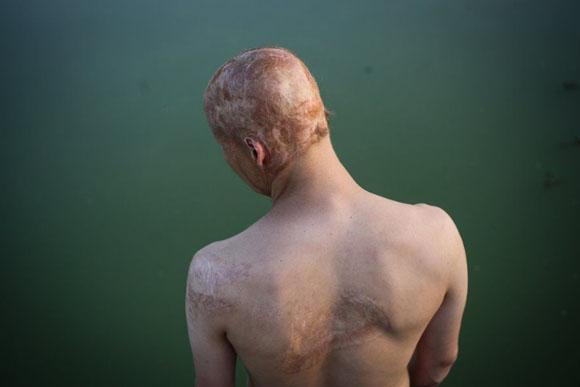 Lyosha, o menino que foi jogado no fogo (Foto: reprodução PAVEL VOLKOV)