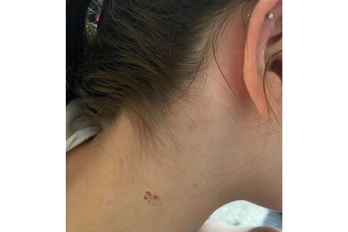A mãe admitiu que a marca foi sumindo conforme a filha foi crescendo