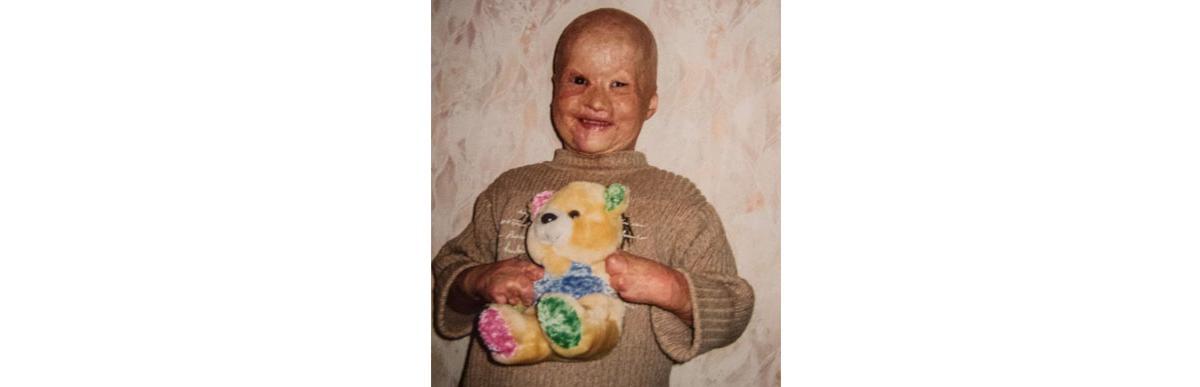 Lyosha, o menino que foi jogado no fogo (Foto: reprodução PAVEL VOLKOV)