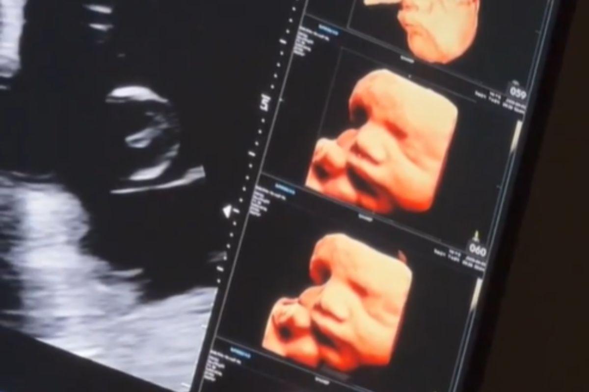 Ultrassom com rosto do bebê Lion filho de Pugliesi