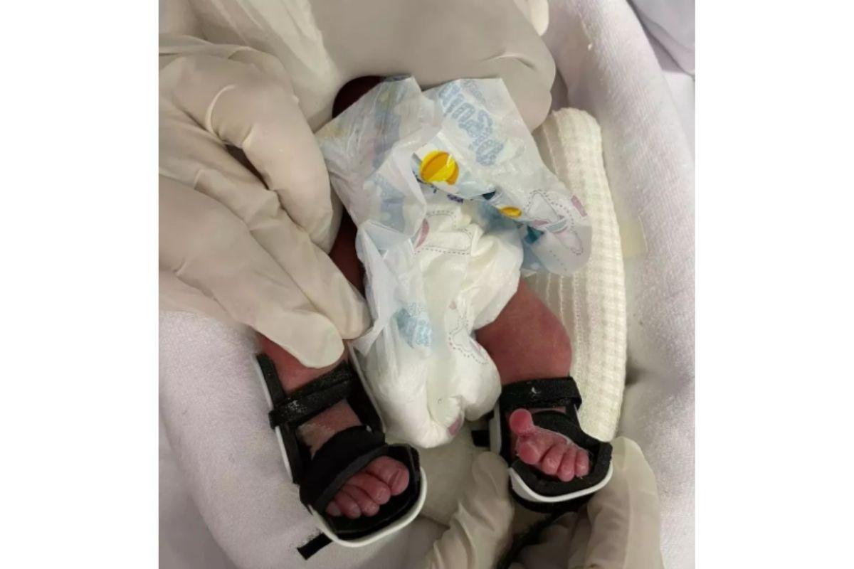 Bebê que nasceu com pés virados recebe órtese feita com impressora 3D