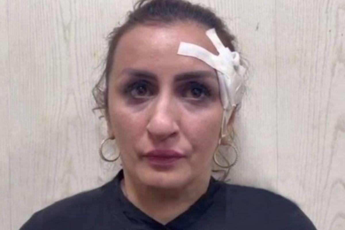 Mulher vende bebê para financiar cirurgia plástica no nariz